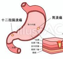 胃潰瘍・十二指腸潰瘍イラスト - No: 22576346｜無料イラスト ...